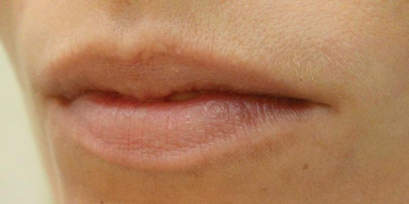 Lips before